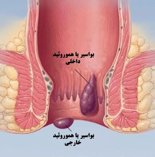 تصویر بواسیر داخلی و خارجی