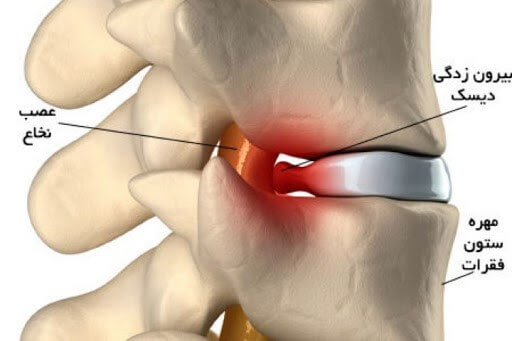 بیرون زدگی دیسک و ایجاد درد ناشی از فشار به عصب نخاع