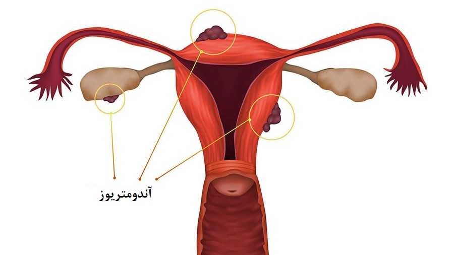 بافت اندومتریوز در تخمدان و دیواره خارجی رحم