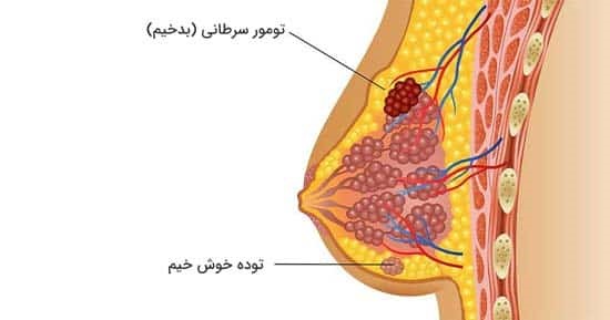 شکل توده سرطان سینه