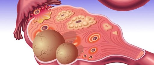 سایزهای مختلف یک کیست در داخل تخمدان