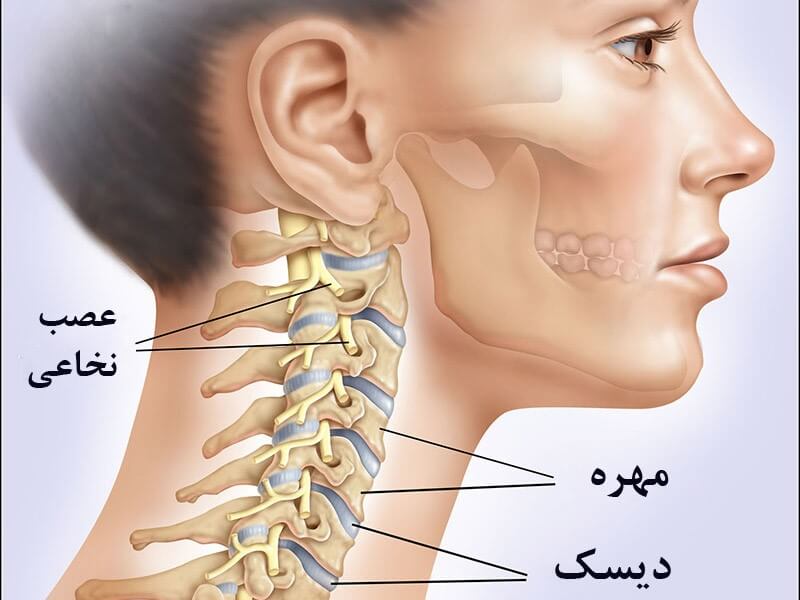 نحوه قرار گرفتن مهره‌ها، دیسک‌ها و عصب نخاعی در گردن