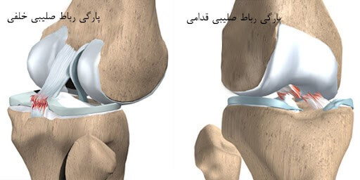 انواعی از پارگی رباط صلیبی پا