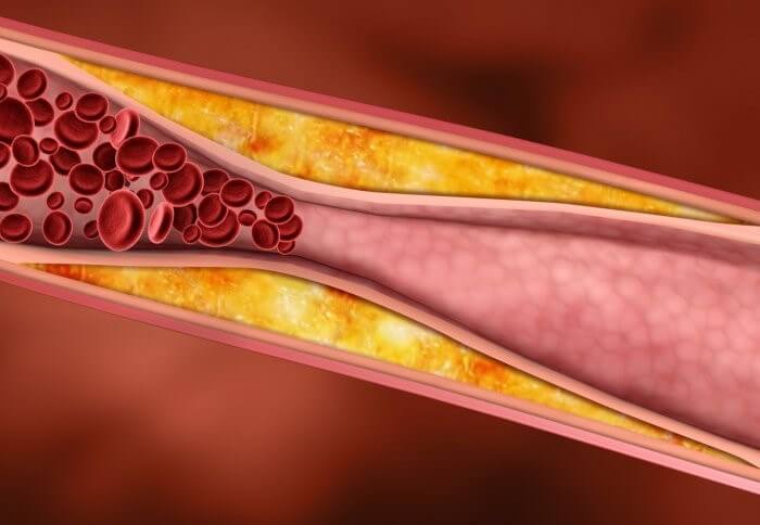 پلاک چربی در دیواره رگ
