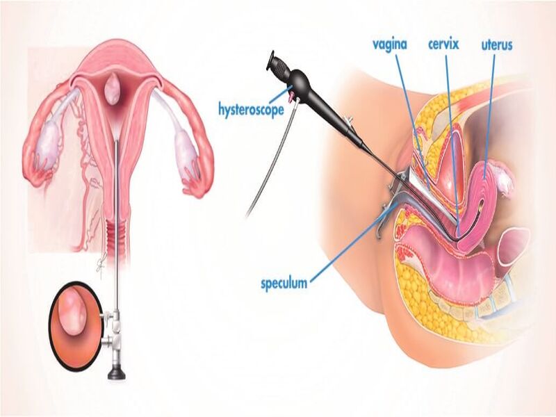هیستروسکوپی چیست؟