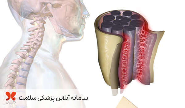 آراکنوئیدیت چیست