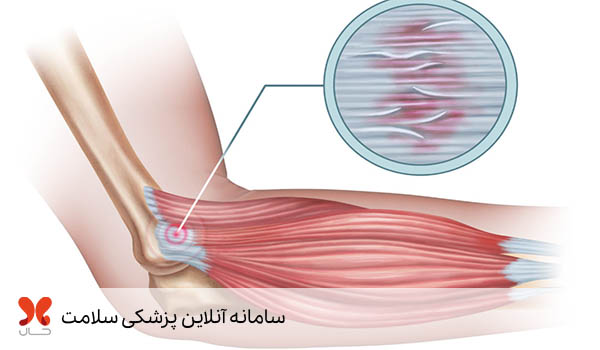 علائم تاندونیت