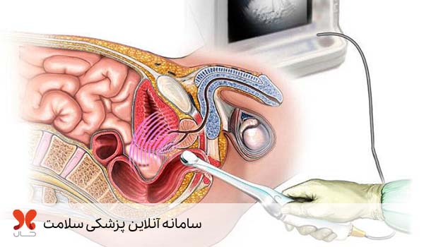 سونوگرافی پروستات