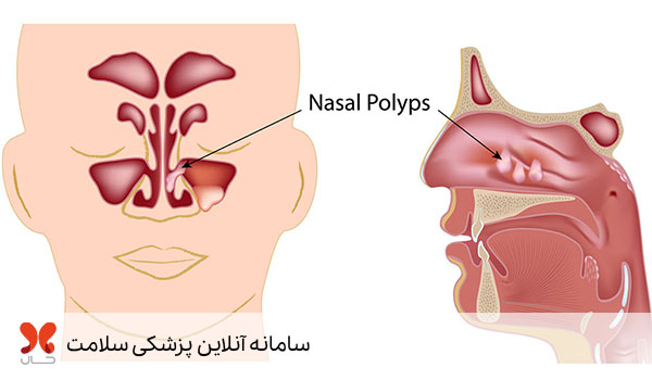 پولیپ بینی چیست