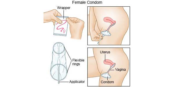 نحوه استفاده از کاندوم داخلی