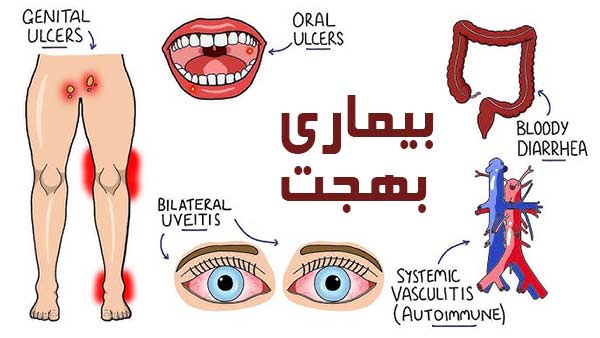 بیماری بهجت چیست