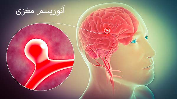 انواع آنوریسم مغزی