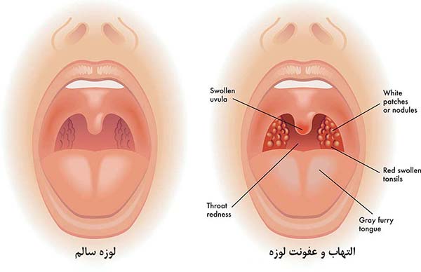 علائم عفونت لوزه