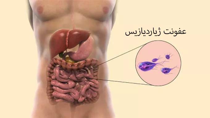 بیماری ژیاردیازیس