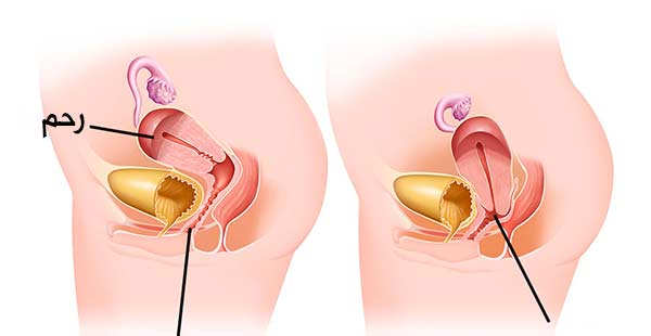 از کجا بدونم افتادگی رحم دارم