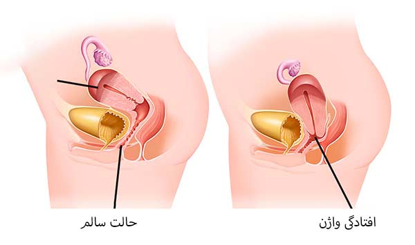 افتادگی واژن چیست؟